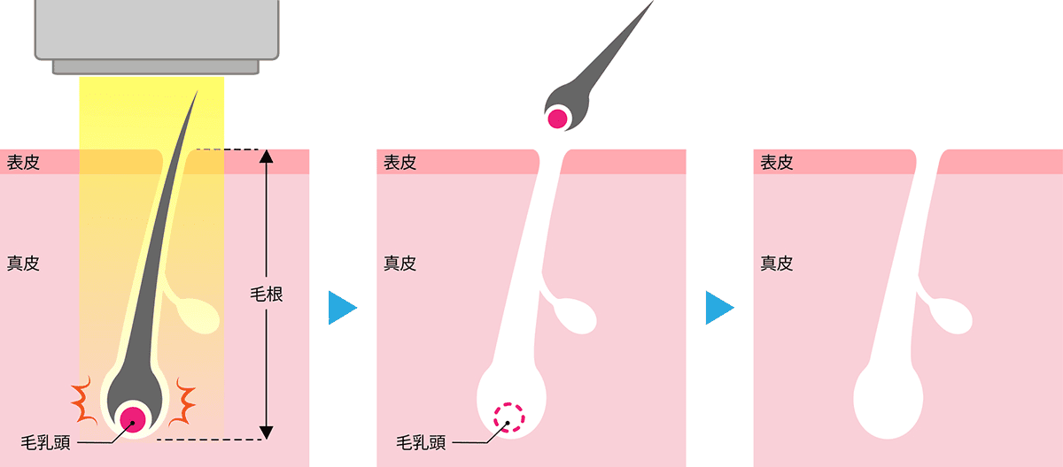 医療脱毛
