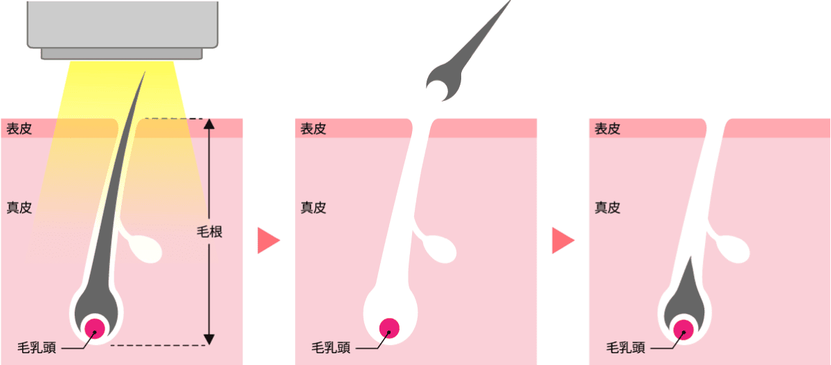 エステ脱毛